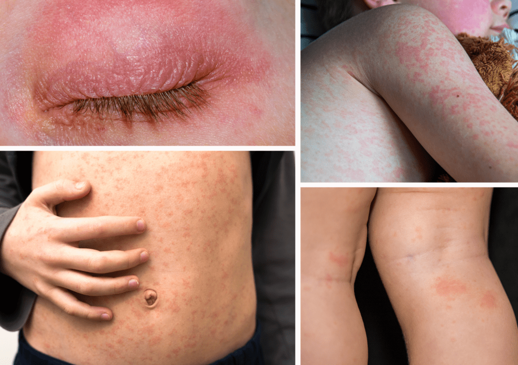 images of Measles rash – Starts as flat, red spots on the face and quickly spreads downward to the chest, arms, and legs